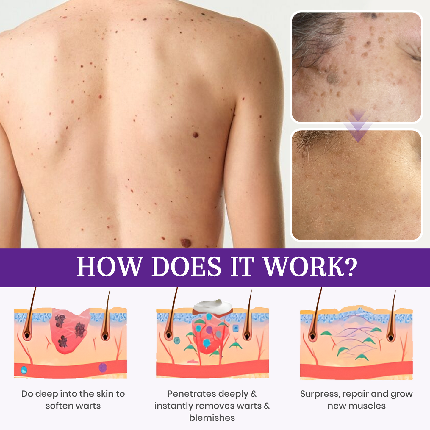 AQA® Instant Mole & Spot Cream