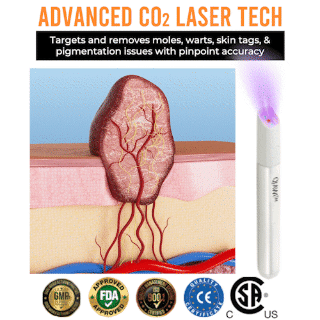 ✨QIAWI™ All-in-One CO₂ Laser Eraser Pen | Removes Moles, Warts, Skin Flaws & Pigmentation