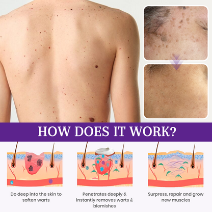 AQA® Instant Mole & Spot Cream